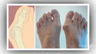 начала болеть косточка на ноге

  - valgus pro применение