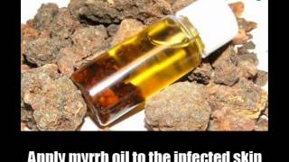 8 Best Cures For Impetigo
