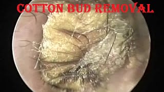 Oto-endoscopic Removal of Forgotten Stuck Cotton bud mixed with Earwax & Hair from ear