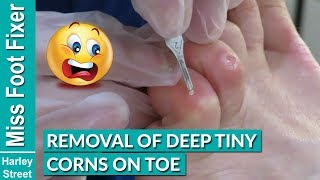 Removal of Deep Tiny Corns on Toes Miss Foot Fixer Marion Yau
