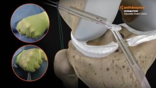 ULTRABUTTON\* Device and BIOSURE\* REGENESORB Screw for ACL Reconstruction with a Hamstring Graft