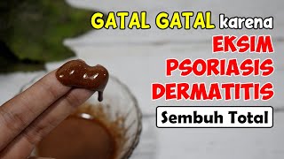 [SUDAH TERBUKTI] CARA MENGOBATI GATAL PADA KULIT YANG TAK KUNJUNG SEMBUH SECARA ALAMI 