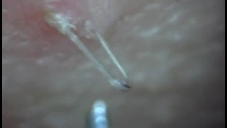 Awesome wirey ingrown hair removed.