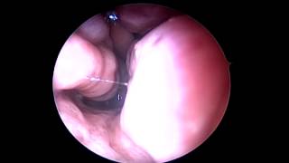 subluxated Inferior turbinate