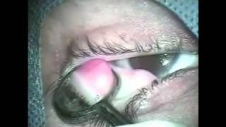 Cirurgia de calázio - Visioncare