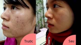 Kem Trị Mụn Owhite - Bí quyết trị mụn hiệu quả ngay tại nhà