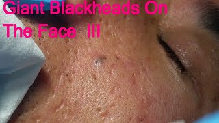 Giant Blackheads - Part III -