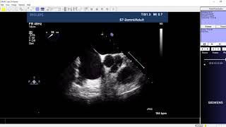 COMPLETE AV CANAL DEFECT (AVCD)