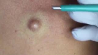 Boil or spot squeezing and lancing
