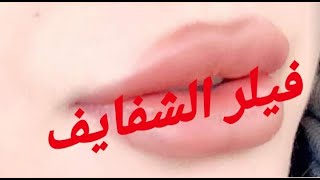 بديل الفيلر لشفايف تجنن (نفخ الشفايف)