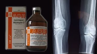 АСД-2Ф в лечении артрита.