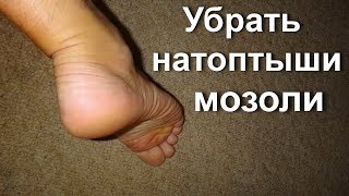 Как избавиться от натоптышей в домашних условиях - № 1 Народное лечение мозоли