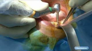 La pose d'un implant en pratique