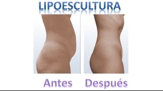 Lipoescultura Laser y Tradicional con Fotos de Antes y Despues y Testimonio de mujer