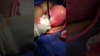 Bloodless total abdominal hysterectomy