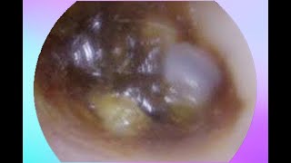 Most Satisfying Ear Clean, Cystic ,Blackheads and Ear Removal - Acne Talk (Part  104)