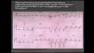 მიოკარდიუმის ინფარქტი და უკანადიაფრაგმული იშემია / თრომბოლიზური თერაპია / სტრეპტოკინაზა / ალტეპლაზა