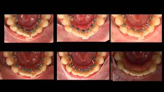 Como se alinean los dientes con ortodoncia lingual?