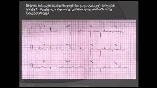 ეკგ / მიოკარდიუმის წინა კედლის ძველი ინფარქტი (შენიღბული კუჭ-ნაწლავის ტრაქტის დაავადებით)