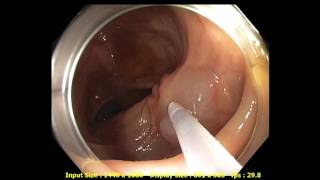 Injection. Clear Jet Injection Catheter