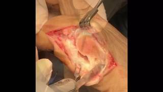 Hallux valgus Chevron Akin