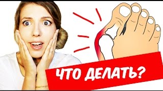 Растет КОСТОЧКА НА ПАЛЬЦЕ ноги – причина, ЛЕЧЕНИЕ // Вальгус, бурсит и деформация пальца