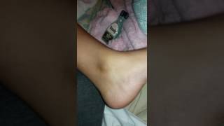 My Daughter Sprained Her Ankle Today