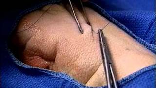 Техника хирургического шва / Suture Technique