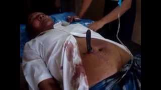 stab wound abdomen