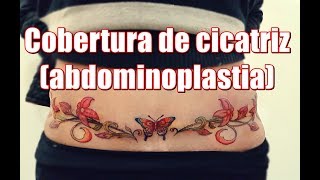 Cobertura de cicatriz (abdominoplastia)
