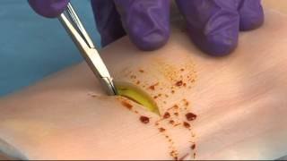 Venous Cutdown