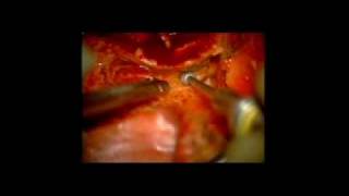 lateral temporal bone resection1