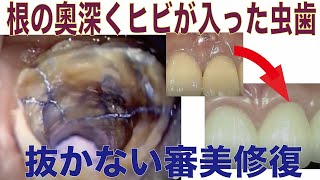 根の奥深くヒビの入った虫歯も抜かずに修復したケース