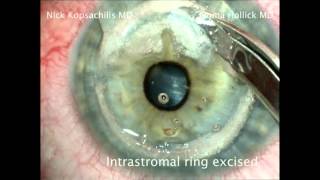 Deep anterior lamellar keratoplasty - intrastromal corneal ring