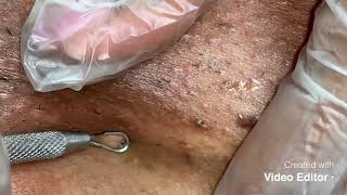 Extractions ( black head / ingrown hair removal )