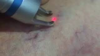 vascualr in leg