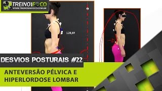 Anteversão Pélvica e Hiperlordose Lombar - Desvios Posturais #22