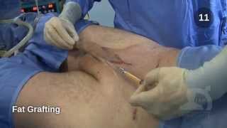 Cosmetic Phalloplasty: Penile Lengthening & Girth Enhancement