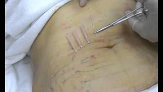 Terapia con FTC® (Fine Thread Contour)- Aplicación en cuerpo
