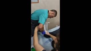 Приклад накладення скотчкаста (Scotchcast) при переломі