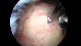 Arthroscopic removal of calcium deposit from shoulder (calcific tendonitis)