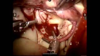 Robotic mitral valve repair with P2 neochords by Charles Anderson, MD