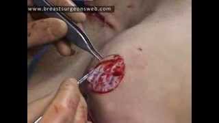 Prophylactic Mastectomy and Type IV Skin Sparing Mastectomy (Mastectomia Profiláctica)