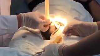 ZSR circumcision always the best choice , believe it and do it