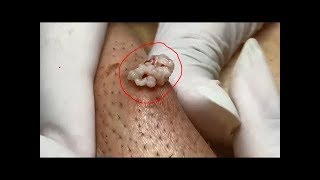 Новое выдавливание ПРЫЩЕЙ и ЧЕРНЫХ ТОЧЕК!  p11