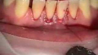 Root Coverage with AlloDerm