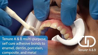 Tenure® A B - 30-Second Dentistry™ - Patient: Kaveh