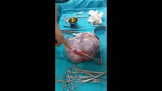 Right Ovarian Cyst in 45 years female presented as Mucinous cyst