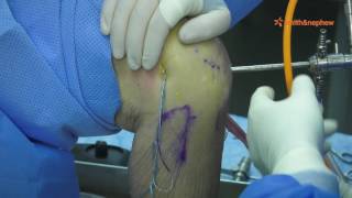 ACL Reconstruction with Hamstring Graft with Dr. Murphy