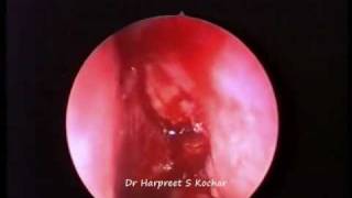 Endoscopic (endonasal) DCR